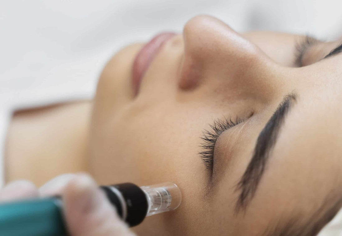 Microneedling treatment
