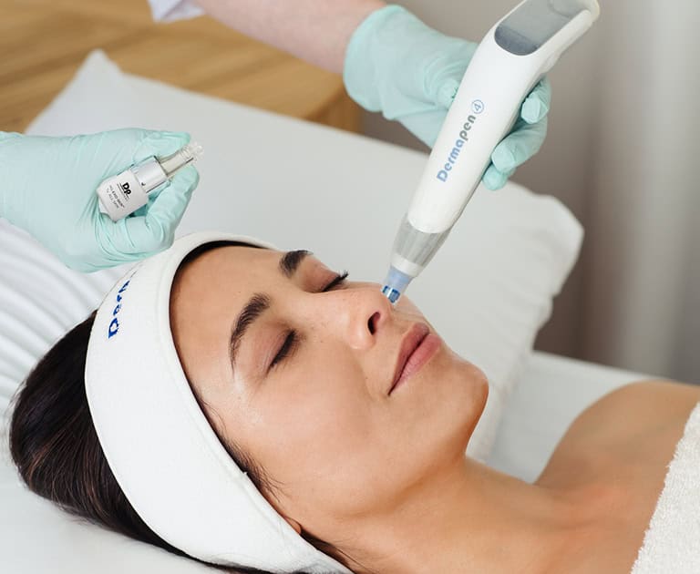 Exosome Skin Needling