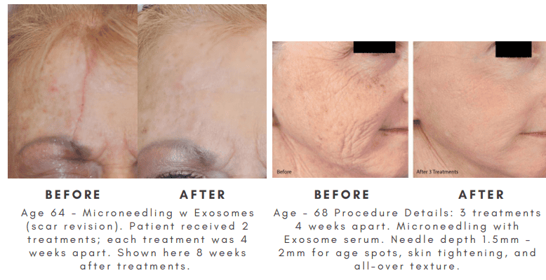 Exosome Skin Before and After